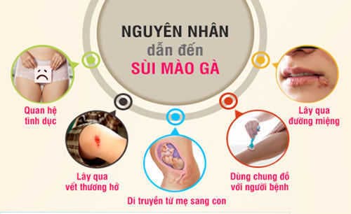 Sùi mào gà